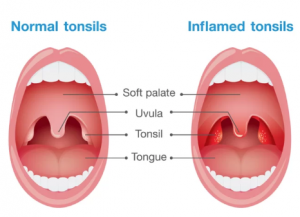 Pus On Tonsil Cause White Spots Back Of Throat Treatment Pictures Healtreatcure