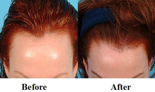 before and after biotin for hair loss