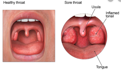 healthy and sore throat