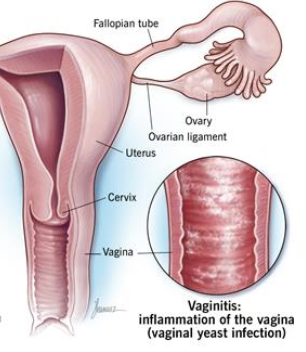 yeast infection in women