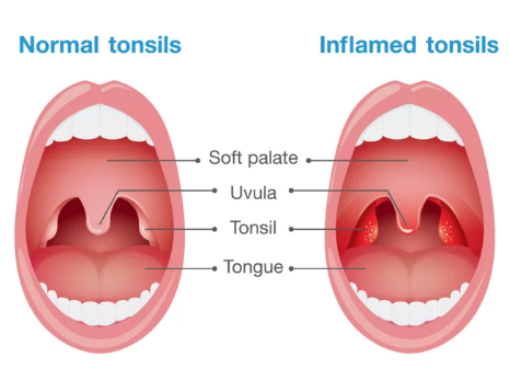 normal and inflamed tonsils