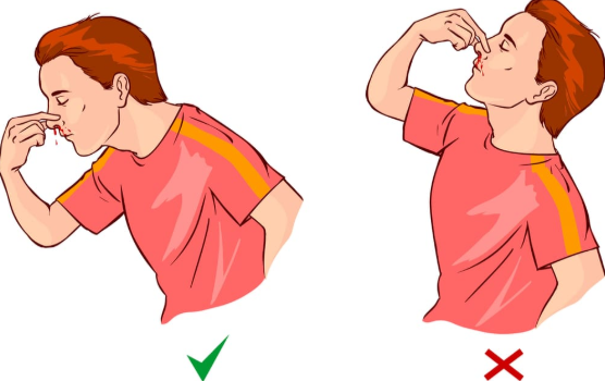 how to stop nosebleed